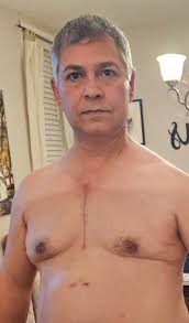 Are these symptoms related to my aortic aneurysm with bicuspid aorta?