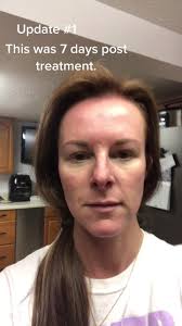 First update 1 week after blue light treatment. #bluelightrecovery  #takecareofyourskin #cancerandprecancer