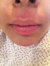 Some guests prefer to come in sooner for areas like their lip, eyebrows, or underarms, says petak. Upper Lip Wax Burn Beautylish