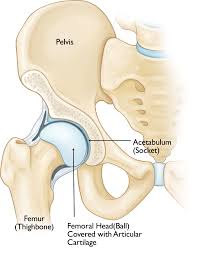 Pain is the most common sign of bone cancer, and may become more noticeable as the tumor grows. Inflammatory Arthritis Of The Hip Orthoinfo Aaos