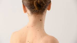 What It Really Means If You Have A Mole In These Places