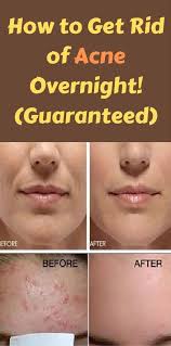 Most targeted spot treatments contain salicylic acid, benzoyl peroxide, or a combo of the two. Best Way To Get Rid Of Acne Overnight Guaranteed Acne Overnight How To Get Rid Of Acne Acne Removal Overnight