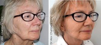 Katrina, from hale, gtr manchester, says: Mini Facelift Jowls Uk Novocom Top