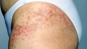 Image result for Vasculitis