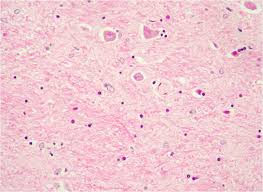 1 Encephalopathy And Other Brain Diseases James S. Kennedy, Md, Ccs, Cdip  President And Chief Medical Officer Cdimd – Physician Champions Smyrna,  Tennessee. - Ppt Download