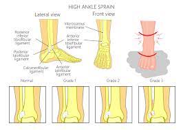 This is often the most common ankle sprain. Sprained Ankle Are They All The Same Evolve Sports Physio