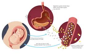 Consult a doctor for medical advice. Gestational Diabetes Doctors Australia