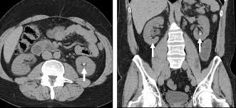 Image result for Nephrolithiasis Imaging