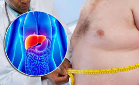 7 best natural remedies for treating fatty liver disease