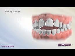 Tongue Thrust Speech Language Therapy Speech Therapy Speech Therapy Materials