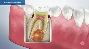 Image result for Periapical Abscess