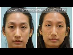 Lower Blepharoplasty & Fat Grafting Testimonial with Dr. Lam in Dallas,  Texas