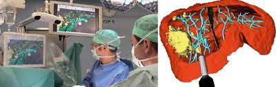 Liver surgery has evolved and improved dramatically in recent years: Soft Tissue Navigation And Liver Surgery Support Radiology Key