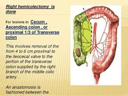 Right Hemicolectomy 1 Only Part Of Transverse Colon Is Removed Not Whole Helse