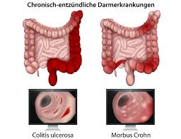 Image result for Ulcerative Colitis