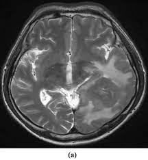 National comprehensive cancer network (nccn). Brain Metastasis Of A Malignant Pleural Mesothelioma A Case Report And Review Of The Literature Sciencedirect