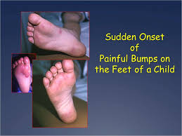 Sudden Painful Bumps On The Feet Of A Child Patient Care Online