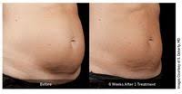 Pin On Body Contouring Sculpsure