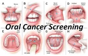Image result for white cancer on tongue)