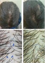 Pumpkin seed oil is the oil that is extracted from cold pressing pumpkin seeds that have been dried, hulled, and roasted. Pumpkin Seed Oil Vs Minoxidil 5 Topical Foam For The Treatment Of Female Pattern Hair Loss A Randomized Comparative Trial Ibrahim Journal Of Cosmetic Dermatology Wiley Online Library