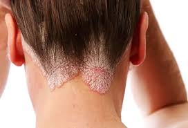 Image result for white scabs on the head in children