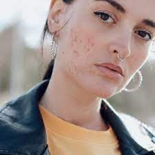 How to treat redness from acne using aspirin? How To Reduce Redness From Acne