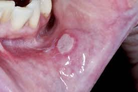 Image result for Mouth ulcers roof of mouth