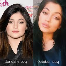 Kylie looks completely different in the pics, which were taken before her lip fillers. Jessicasimien Com Kylie Jenner Plastic Surgery Facial Plastic Surgery Celebrity Plastic Surgery