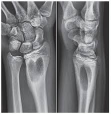 Image result for Osteomyelitis XRay