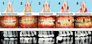 We did not find results for: Periodontal Disease