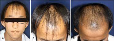 Once you get a specific diagnosis, then you can know the causes this very common form of hair loss is caused by haircare and hairstyle practices — practices which place. A Clinical Photo Of 17 Year Old Male With Diffuse Hair Loss Bulbous Download Scientific Diagram