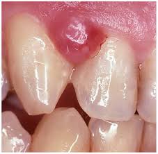 Image result for granuloma gum disease