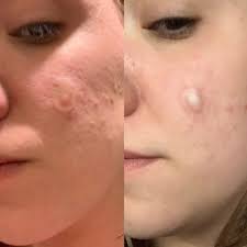 Just be sure to apply the patch onto clean skin, right after a. 42 Products With Before And After Photos So Incredible They Belong In The Hall Of Fame Purple Shampoo Drugstore Skincare Zits