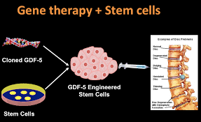 Disc Degeneration Therapy Joshua Li Md Phd