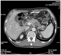 Testicular cancer is one of the most common cancers for men ages 15 to 35, but it's very treatable. Metastatic Testicular Tumor Presenting As A Scrotal Hydrocele An Initial Manifestation Of Pancreatic Adenocarcinoma