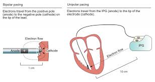 Maybe you would like to learn more about one of these? Components And Construction Of A Pacemaker Ecg Echo