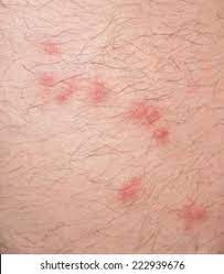 Flea Bite High Res Stock Images Shutterstock