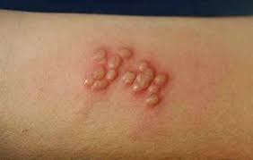 Image result for genital herpes