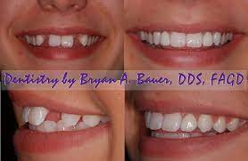 A type of retainer with fake teeth called flipper dentures can be used to fill these gaps right away. Dental Flipper Choices What Are Your Options What S Cost