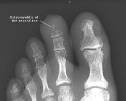 Image result for Osteomyelitis XRay