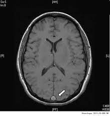 Signos imaginológicos y errores frecuentes. Trombosis Venosa Cerebral Aspectos Actuales Del Diagnostico Y Tratamiento Neurologia