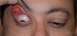 How to flip your eyelids inside out. Floppy Eyelid Syndrome