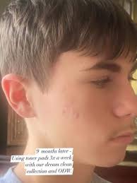 I have heavily struggled with acne from the time I was in high school up  until even now as a 25 year old. I've gone to dermatologists,  aesthetitians, tried chemical peels, topicals,