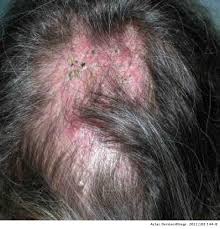 Quickly, make sure you take the free hair quiz later in this article. Tinea Capitis In Elderly Women A Report Of 4 Cases Actas Dermo Sifiliograficas
