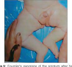 Prior to the 1900s it was the designation of a fire tender. Necrotizing Scrotum Fasciitis Fournier S Gangrene In An Infant A Case Report And Review Of The Literature Semantic Scholar