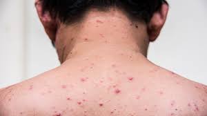 The stages of hiv infection are acute infection (also known as primary infection), latency and aids. Chickenpox In Adults Superdrug Health Clinic