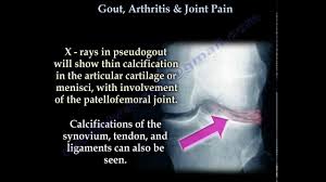 Image result for gout symptoms knee