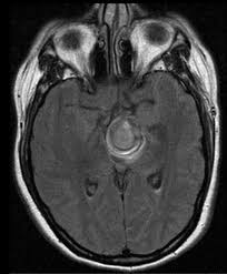 Brain aneurysms are dangerous because they can burst, causing bleeding within or on the outer. Thrombosed Berry Aneurysm Radiology Case Radiopaedia Org