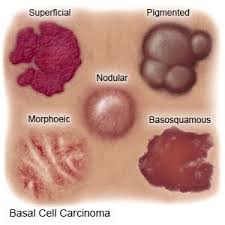 Tumors with nerve involvement, lymph node involvement or. Basal Cell Carcinoma Inpatient Care What You Need To Know