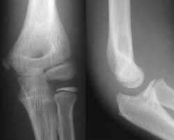 Projectional Radiography Wikipedia